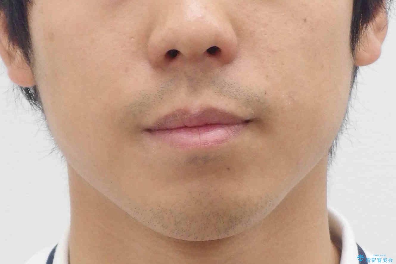 歯を抜かない矯正 奥歯のすれ違い咬合 下の八重歯 の治療前(顔貌)
