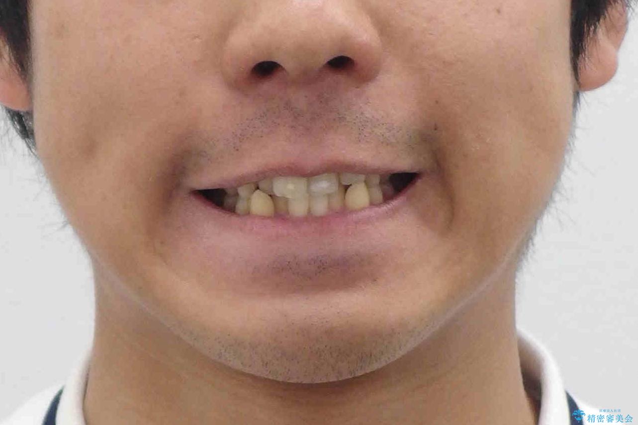 歯を抜かない矯正 奥歯のすれ違い咬合 下の八重歯 の治療前(顔貌)