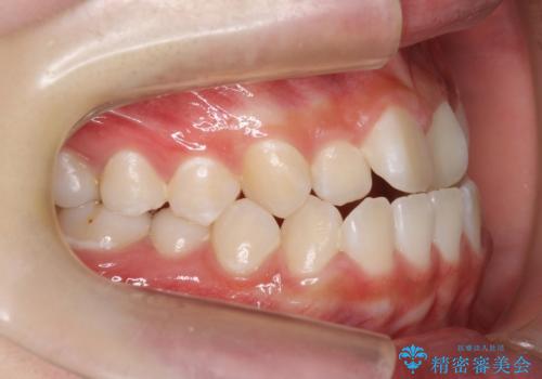 受け口 親知らずを取り込む矯正治療の治療前