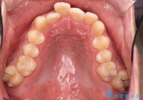 歯を抜かない矯正 奥歯のすれ違い咬合 下の八重歯 の治療前