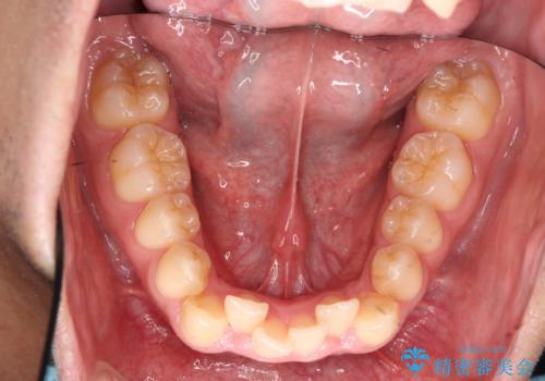 歯を抜かない矯正 奥歯のすれ違い咬合 下の八重歯 の治療前