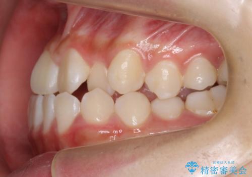 受け口 親知らずを取り込む矯正治療の治療前