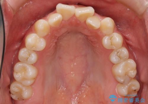 受け口 親知らずを取り込む矯正治療の治療前