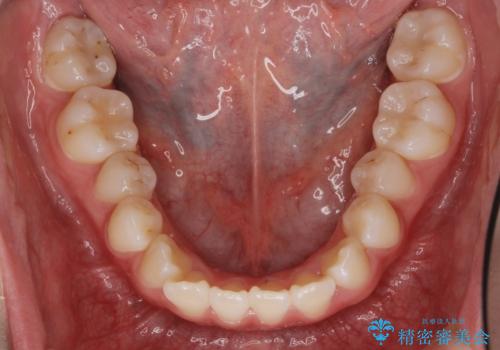 受け口 親知らずを取り込む矯正治療の治療前