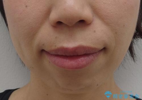 口ゴボでお悩みの方必見! 不自然なセラミックをやり直す矯正 セラミックだけでは、口元は下がりません。の治療前