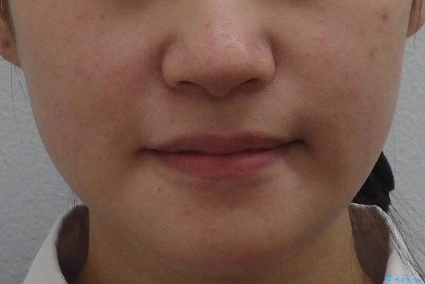 受け口 親知らずを取り込む矯正治療の治療前(顔貌)