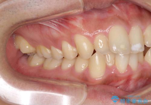 歯を抜かない矯正 奥歯のすれ違い咬合 下の八重歯 の治療前