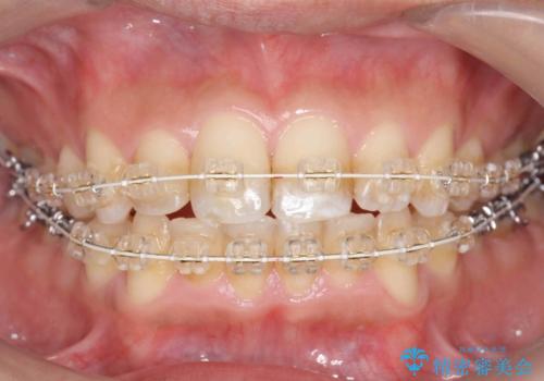 歯を抜かない矯正 奥歯のすれ違い咬合 下の八重歯 の治療中