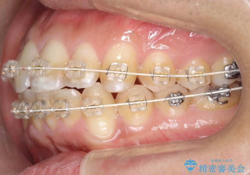 歯を抜かない矯正 奥歯のすれ違い咬合 下の八重歯 の治療中