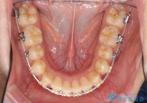 歯を抜かない矯正 奥歯のすれ違い咬合 下の八重歯 の治療中