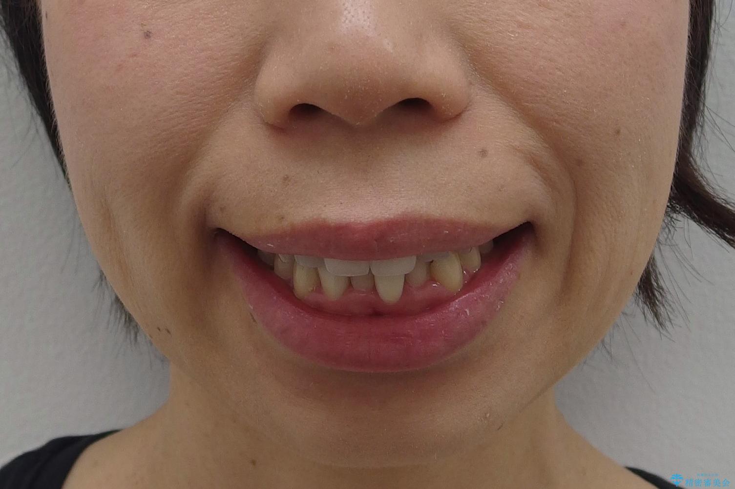 口ゴボでお悩みの方必見! 不自然なセラミックをやり直す矯正 セラミックだけでは、口元は下がりません。の治療前(顔貌)