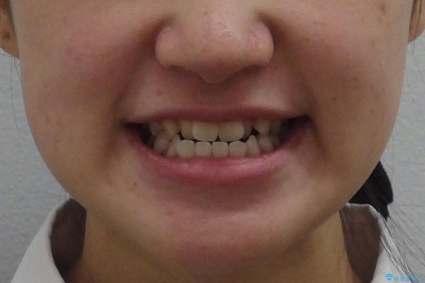 受け口 親知らずを取り込む矯正治療の治療前(顔貌)