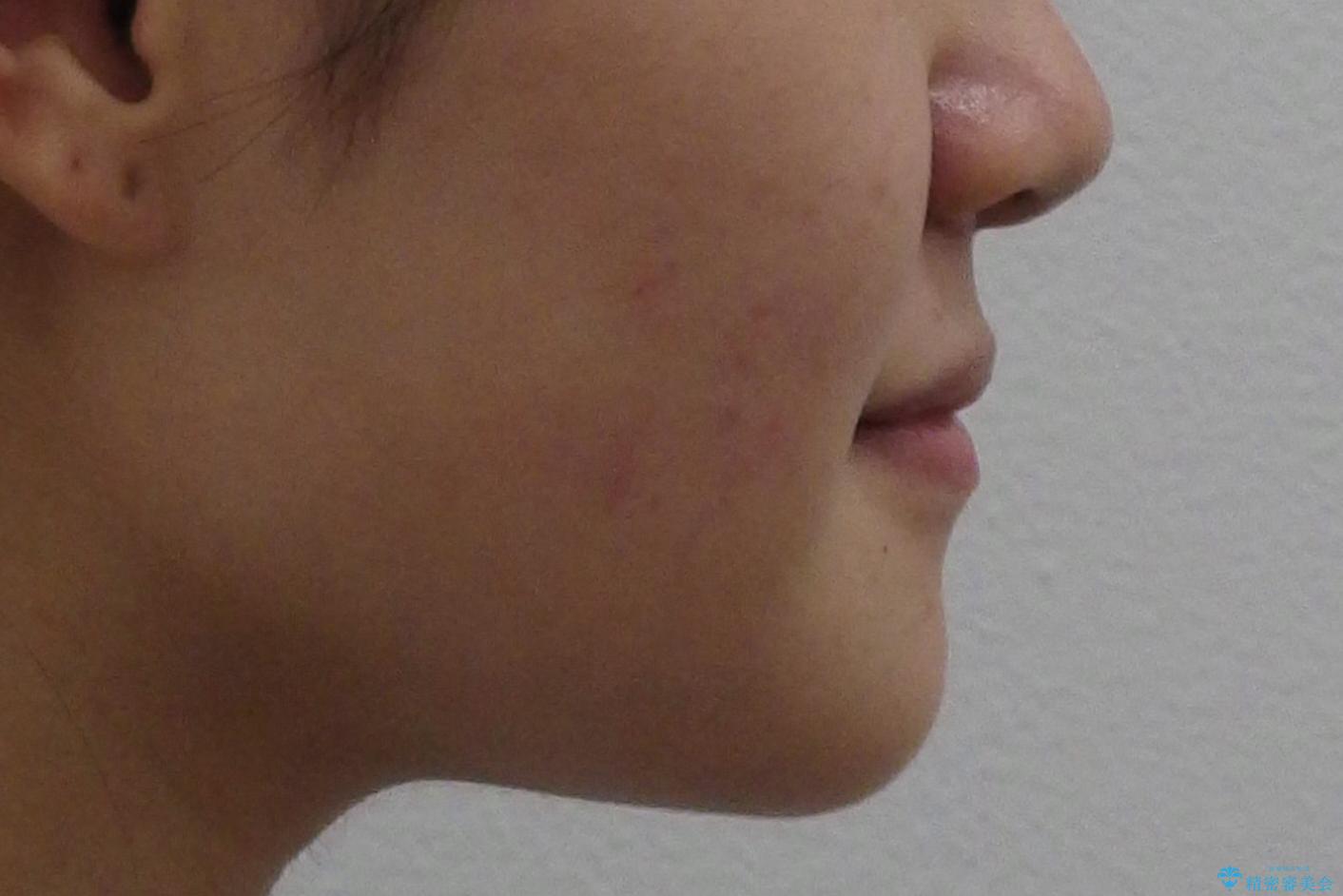 受け口 親知らずを取り込む矯正治療の治療前(顔貌)