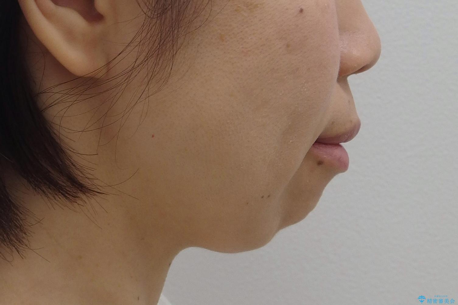 口ゴボでお悩みの方必見! 不自然なセラミックをやり直す矯正 セラミックだけでは、口元は下がりません。の治療前(顔貌)