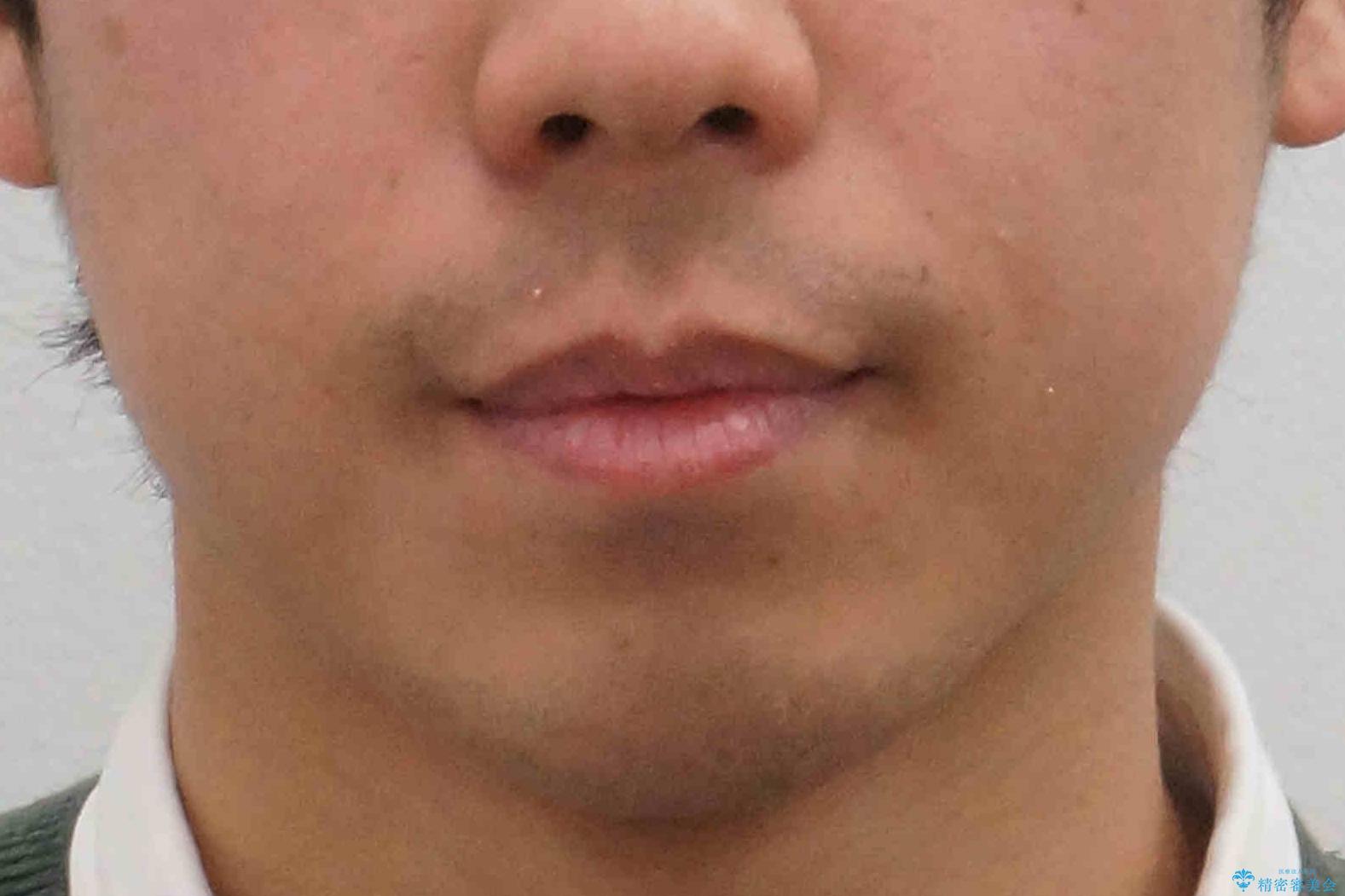 歯を抜かない矯正 奥歯のすれ違い咬合 下の八重歯 の治療後(顔貌)