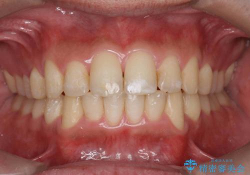歯を抜かない矯正 奥歯のすれ違い咬合 下の八重歯 の症例 治療後