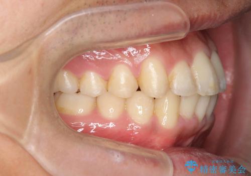 歯を抜かない矯正 奥歯のすれ違い咬合 下の八重歯 の治療後