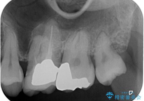 痛みの続いた歯を原因から治療の治療前