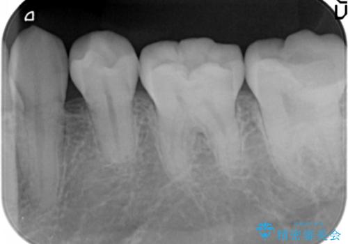 他院で次に虫歯になったら治せないと言われた 歯周外科手術でしっかり治療(APF)の治療前
