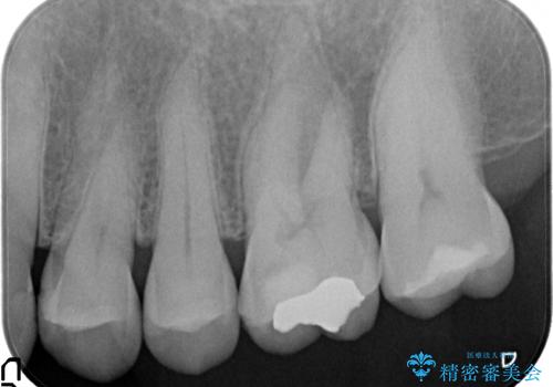 オールセラミッククラウン 精密根管治療~神経が死んでしまった歯の治療~の治療前