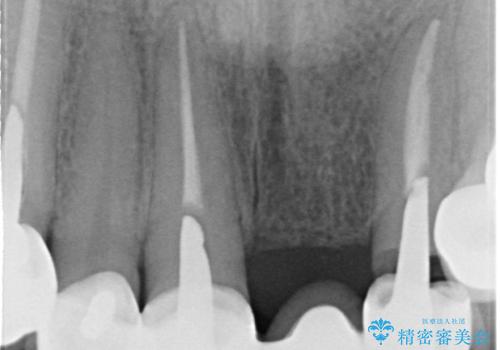 前歯ブリッジのやりかえの治療前