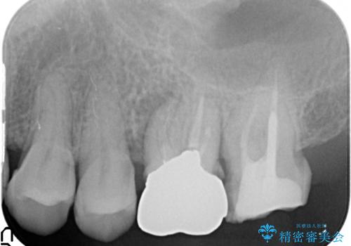 オールセラミッククラウン 疼く奥歯の治療の治療前