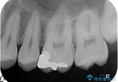 オールセラミッククラウン ズキズキ痛む歯の治療の治療前