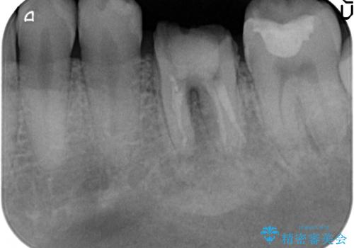 放置してしまった歯 根管治療からの機能回復の治療前