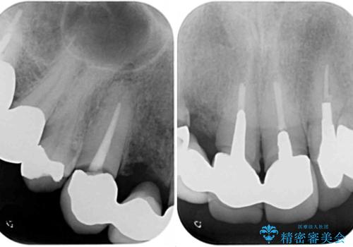 欠けてしまった前歯のブリッジをオールセラミックブリッジへの治療前