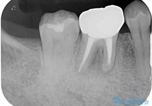金属の縁が見えてしまったクラウン オールセラミッククラウンで審美的にの治療後