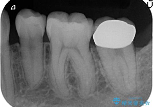 オールセラミッククラウン　奥歯の虫歯・深いポケットの除去の治療後
