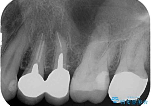 古くなったメタルボンドをオールセラミッククラウンにの治療前
