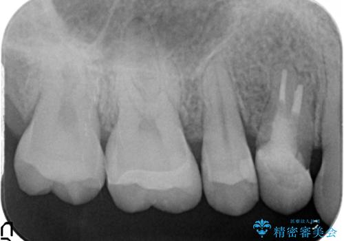 セラミックインレー 痛む歯の治療の治療後
