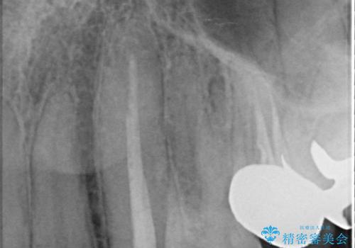 オールセラミッククラウン(スペシャル) より綺麗な歯への治療前