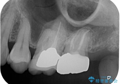 痛みの続いた歯を原因から治療の治療後