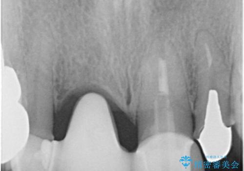 汚れてしまった前歯の仮歯 オールセラミッククラウンにて自然にの治療前