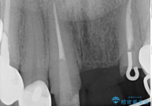 前歯ブリッジのやりかえの治療後