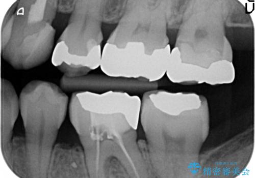 犬歯の変色 マウスピースで手軽にエクストリュージョン 歯ぐきの炎症をおさめますの治療前