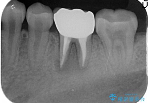 オールセラミッククラウン 他院にて抜歯と言われた歯の治療の治療後