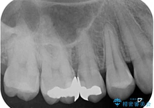 奥歯のむし歯治療　セラミックとゴールドインレーの治療前