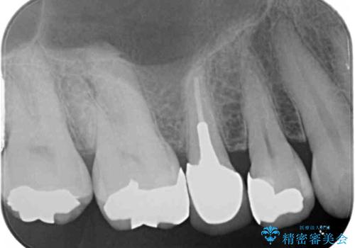 古くなったメタルボンドをオールセラミッククラウンにの治療前
