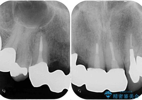 欠けてしまった前歯のブリッジをオールセラミックブリッジへの治療後
