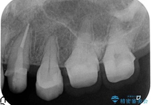 犬歯の変色 マウスピースで手軽にエクストリュージョン 歯ぐきの炎症をおさめますの治療中