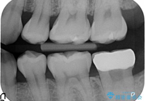 他院で次に虫歯になったら治せないと言われた 歯周外科手術でしっかり治療(APF)の治療後
