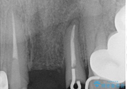 前歯ブリッジのやりかえの治療後