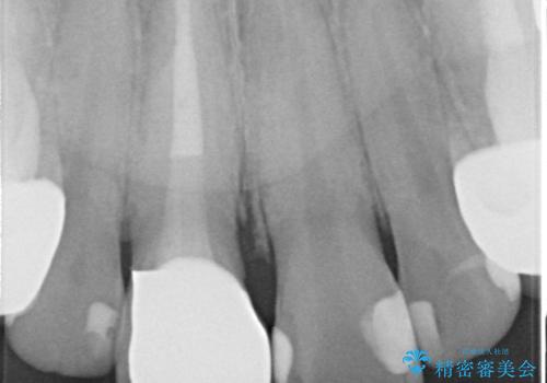 オールセラミッククラウン(スペシャル)　不揃いな前歯を綺麗にの治療後