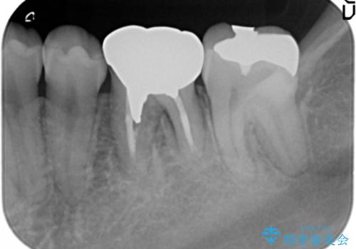 セラミックインレー 下の一番奥歯 歯ぐきの厚みを減らしてぴったりに入れます(ディスタルウェッジ+骨外科)の治療前