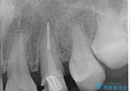犬歯の変色 マウスピースで手軽にエクストリュージョン 歯ぐきの炎症をおさめますの治療中