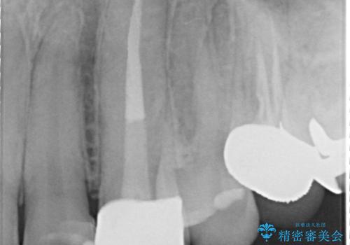 オールセラミッククラウン(スペシャル) より綺麗な歯への治療後