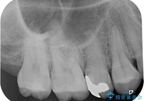 奥歯のむし歯治療 セラミックとゴールドインレーの治療後